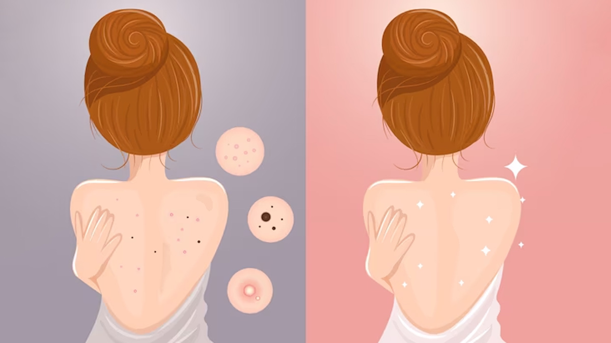 Conditioner Causes Body Acne